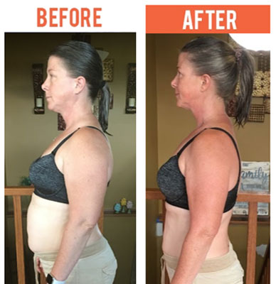 Weight Loss Plymouth MN Before and After
